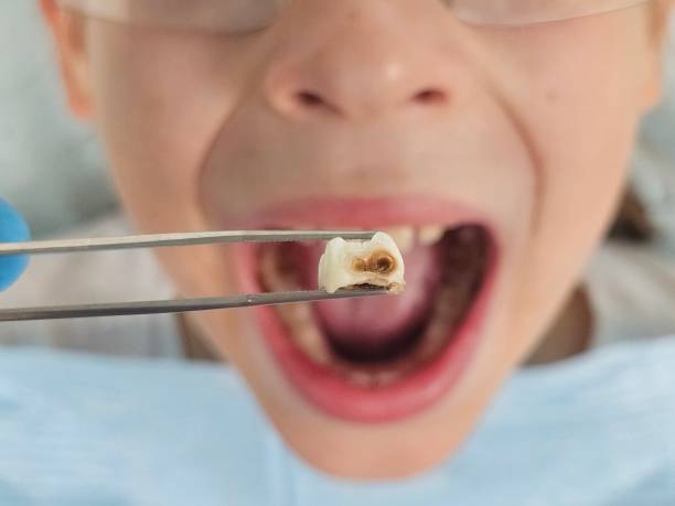 Best Emergency Tooth Extraction in Cos Co, CT